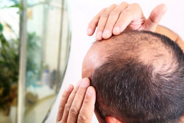 داروی ماینوکسیدیل خوراکی جدید