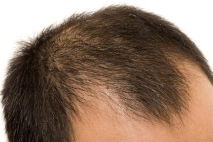 داروی ماینوکسیدیل خوراکی جدید